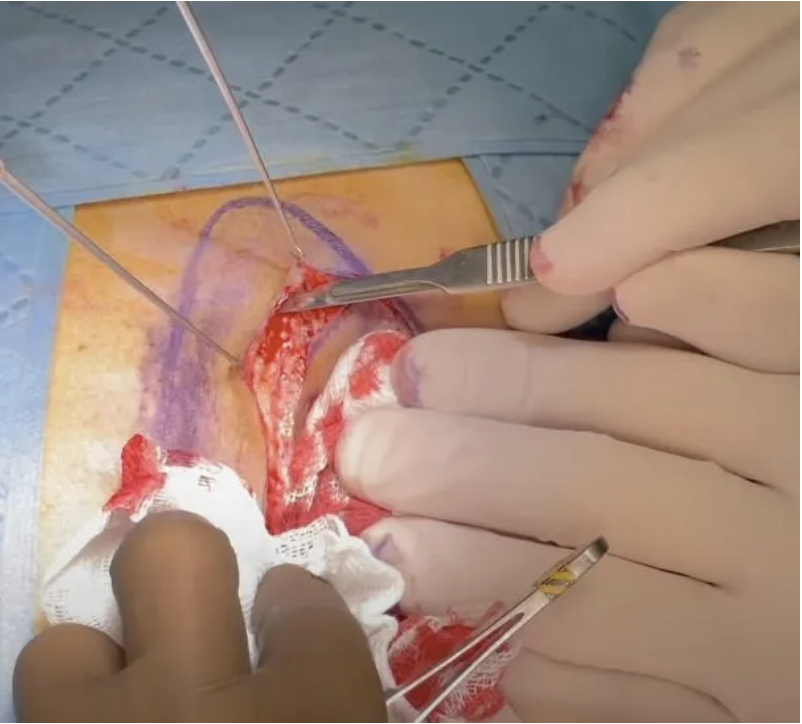 Cleft-lift surgical procedure being performed