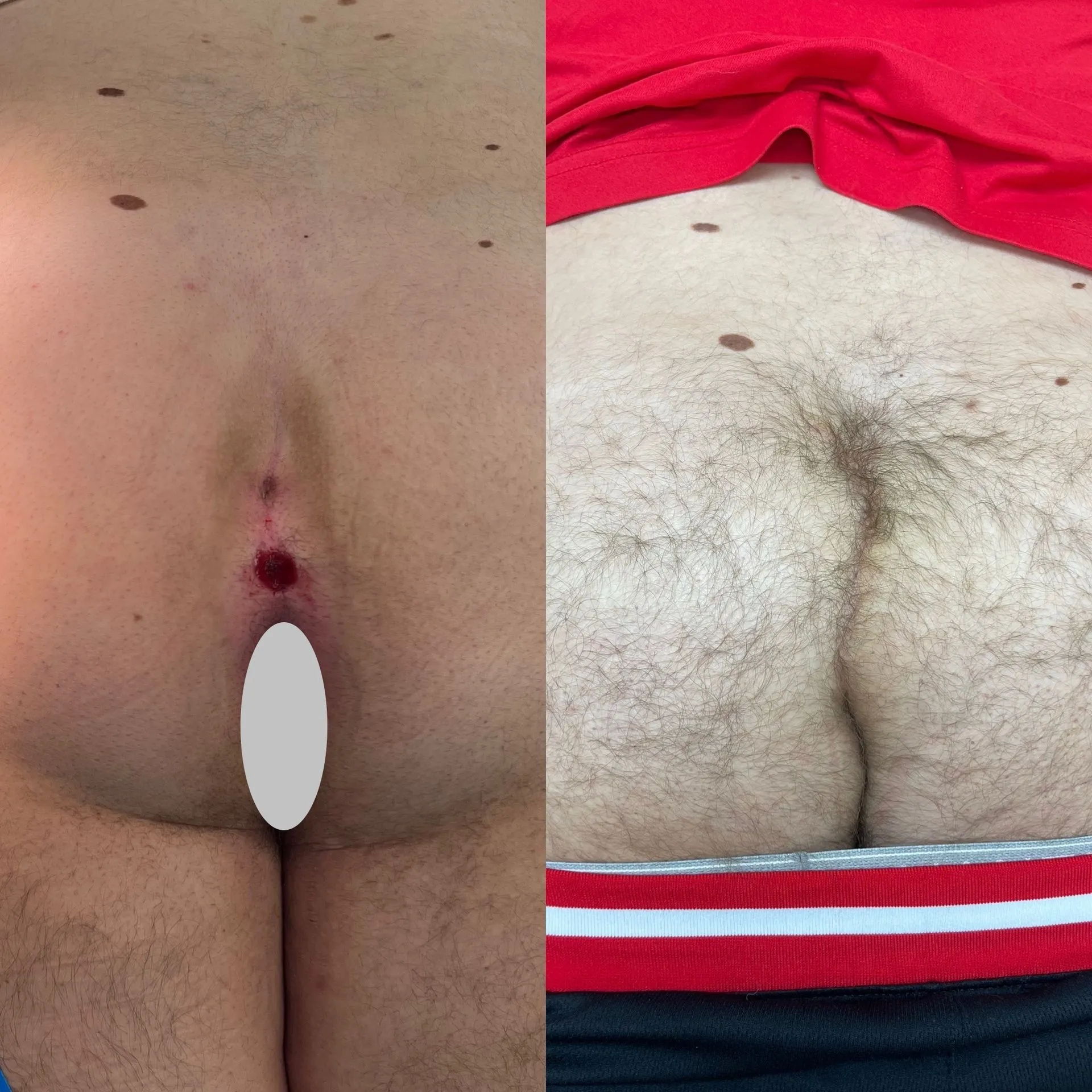 Cleft lift surgery before and after, patient 2, full healing at 3 to 10 weeks post-op
