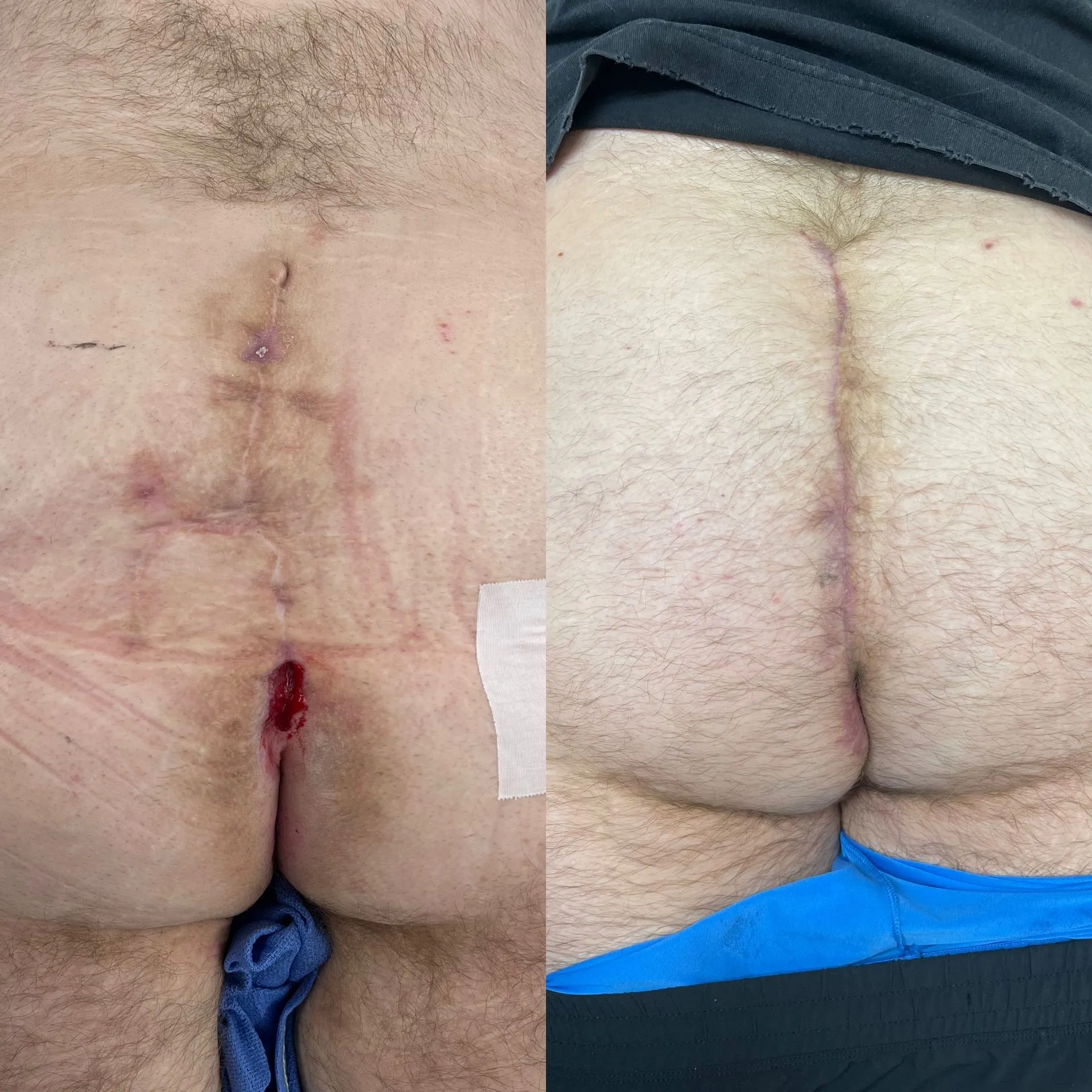 Cleft lift surgery before and after, patient 4, full healing at 3 to 10 weeks post-op