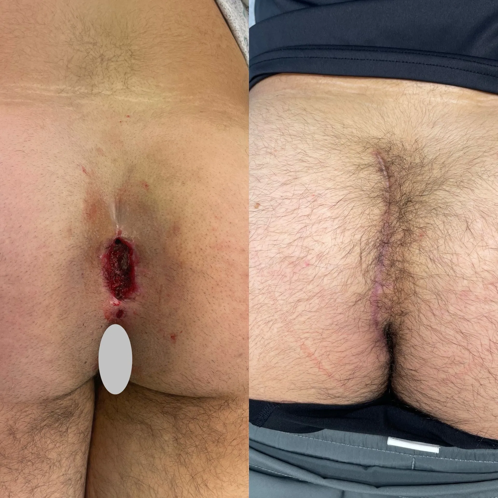 Cleft lift surgery before and after, patient 6, full healing at 3 to 10 weeks post-op