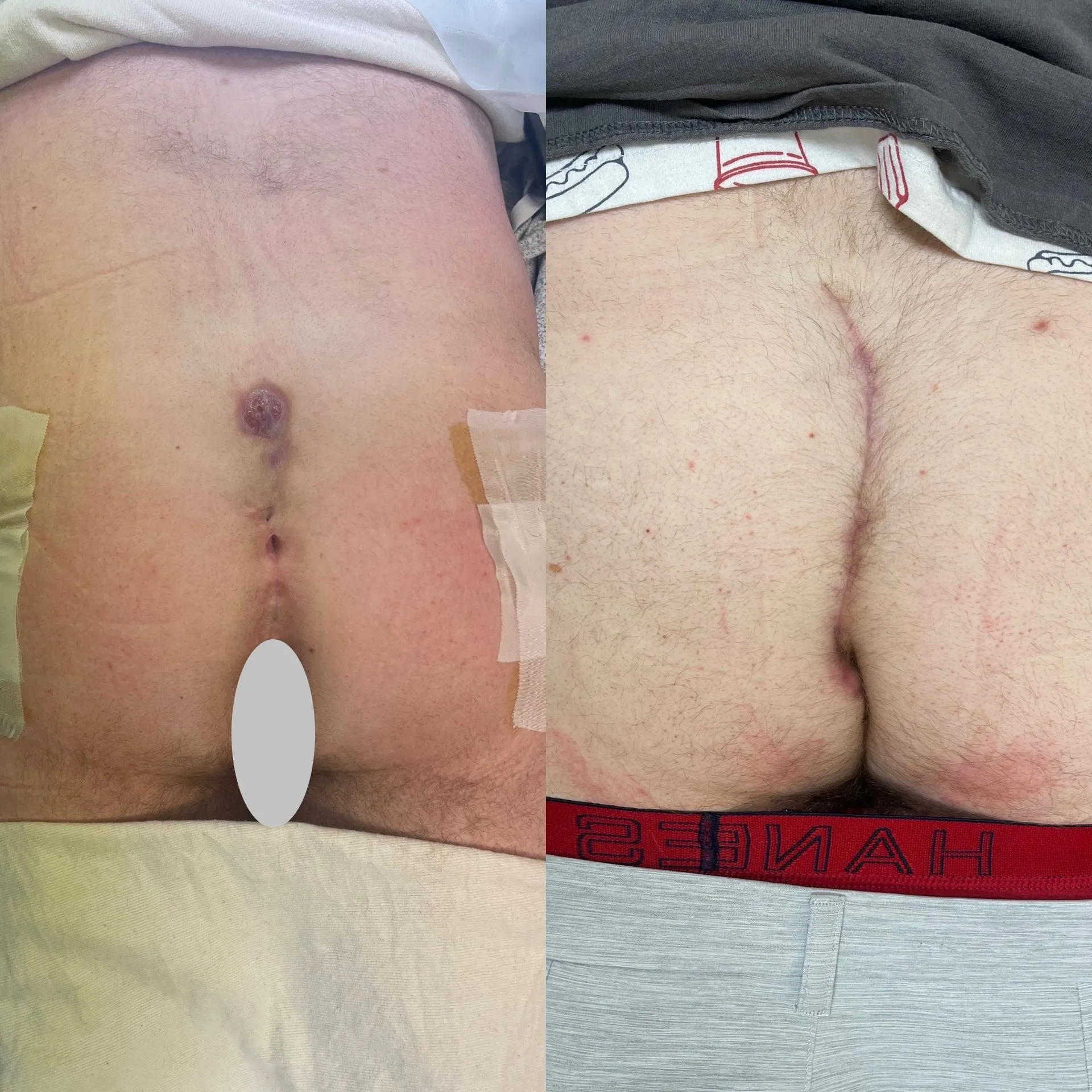 Cleft lift surgery before and after, patient 7, full healing at 3 to 10 weeks post-op