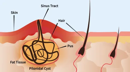 Diagram showing pilonidal cyst anatomy with skin, sinus tract, hair, pus, fat tissue, and cyst