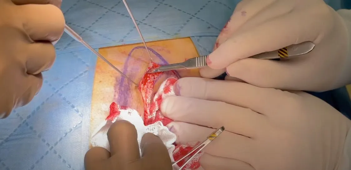 Pit-picking surgical procedure being performed